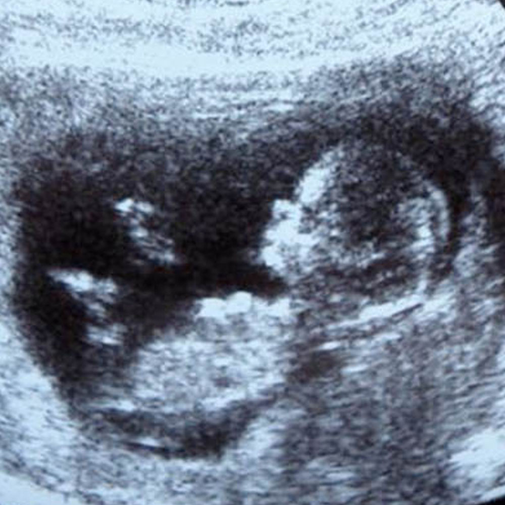 Abortion Education